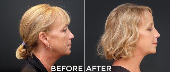 Before and After Pictures
