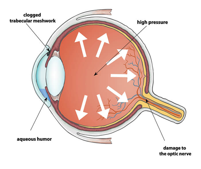 Diagram of Glaucoma