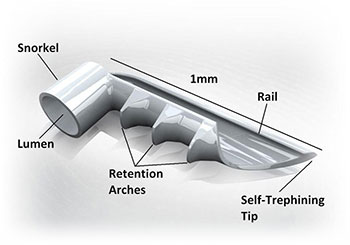 iStent Informational Diagram