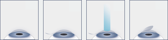 LASIK Eye Surgery Naples LASIK Eye Surgery Procedure Diagram