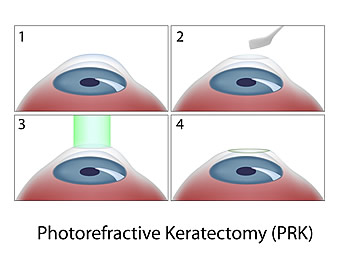 PRK Naples PRK Diagram