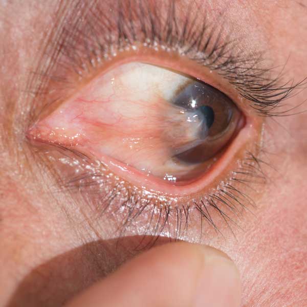 Image of Pterygium