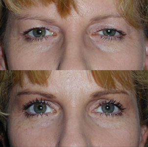Blepharoplasty Naples Blepharoplasty Before and After