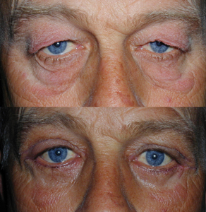 Eyelid Surgery Naples Eyelid Surgery Before and After