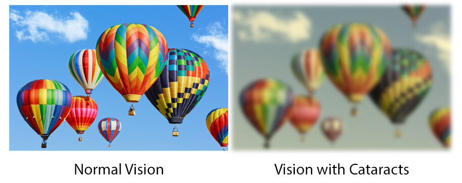 Normal vision versus vision with Cataracts