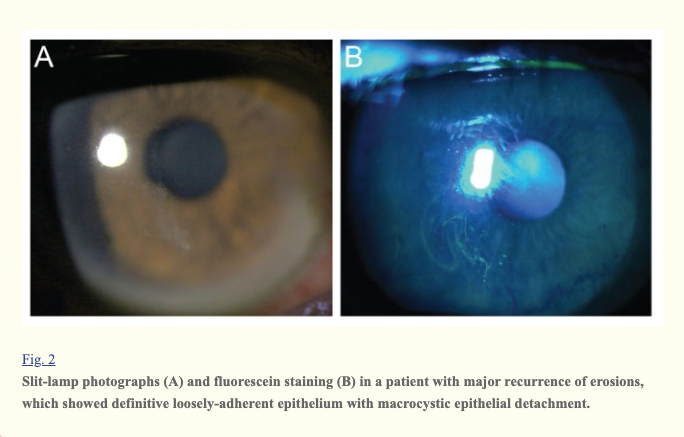 Slit-lamp photographs (A) and fluorescein staining (B) in a patient with minor recurrence. Microcystic epithelial irregularities were observed without definitive epithelial defect.