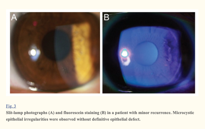 Slit-lamp photographs (A) and fluorescein staining (B) in a patient with major recurrence of erosions, which showed definitive loosely-adherent epithelium with macrocystic epithelial detachment.