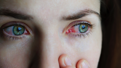 Young woman with eye inflammation suffering from Uveitis