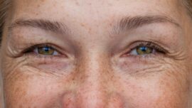 Rhinoplasty